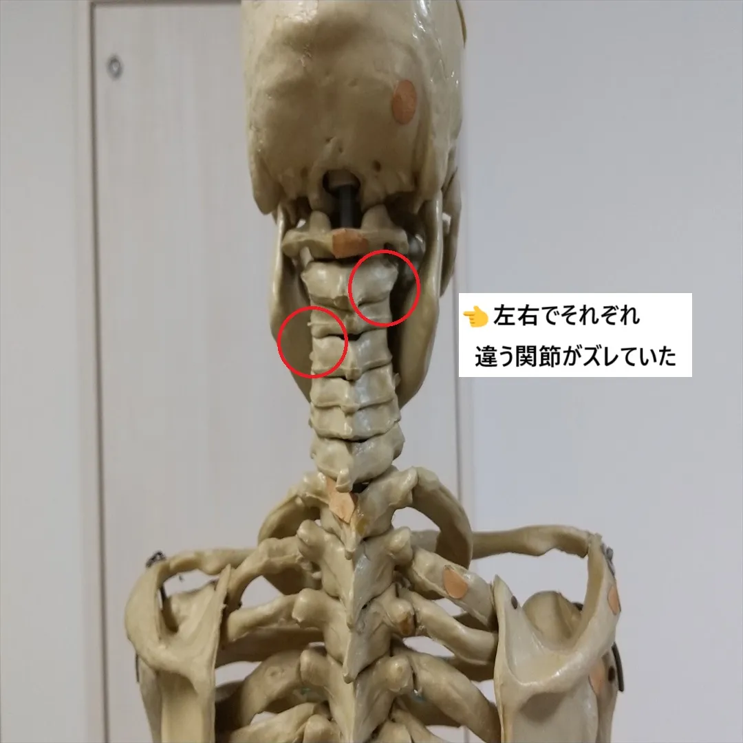 【痛みのある肩こり】
