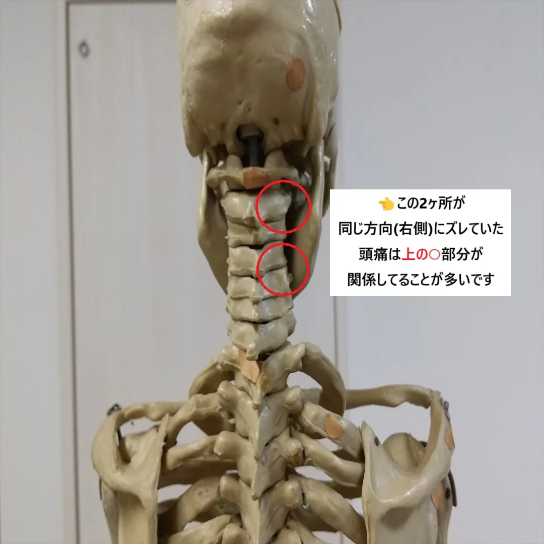 【首の痛みと頭痛】