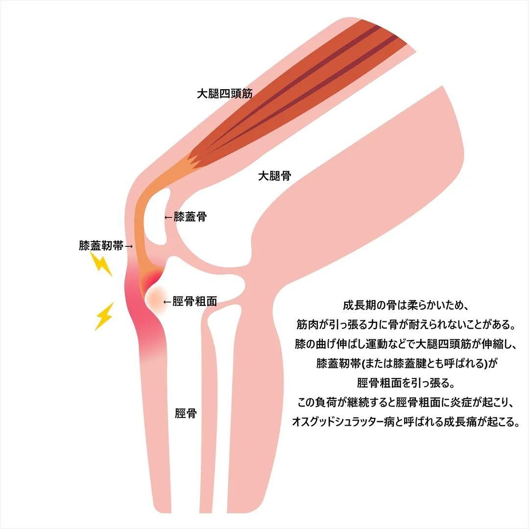 【膝の成長痛】