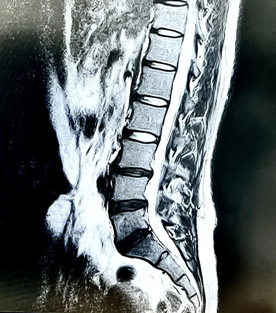 腰部脊柱管狭窄症の原因と対策